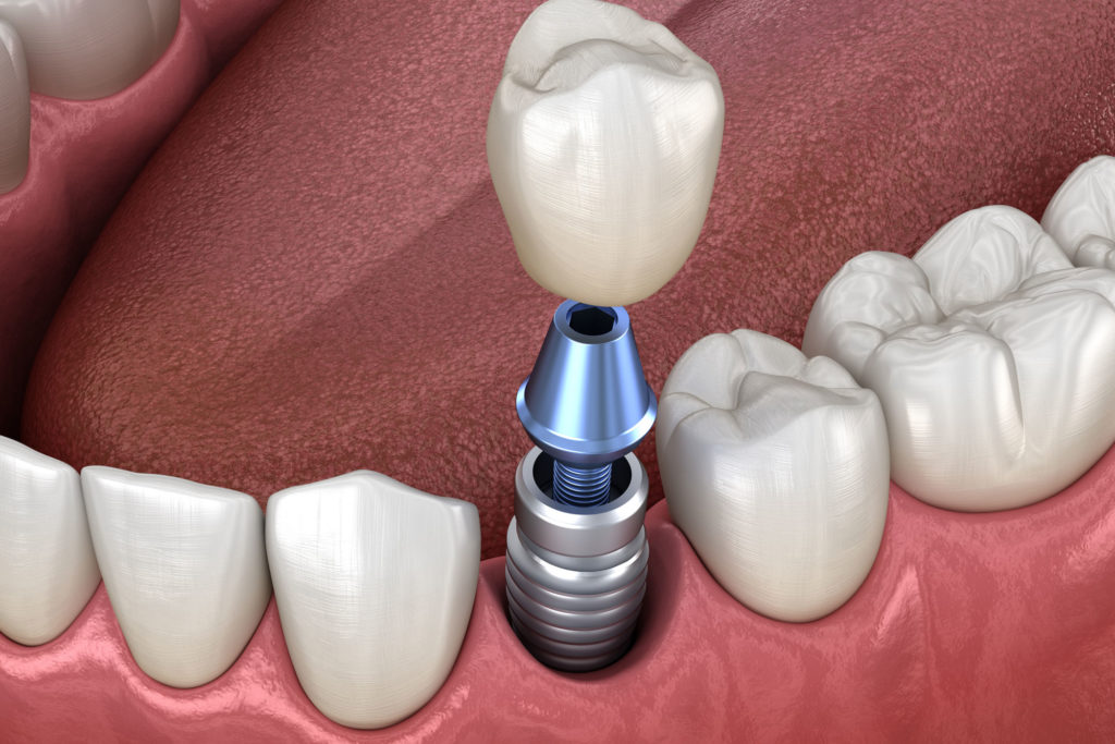 dental implant model Dana Point CA