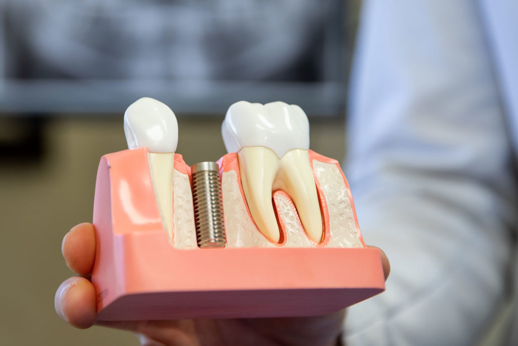 dental implant model Dana Point CA