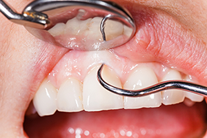 Gum disease - Gentle Dentistry - Haworth, Nj